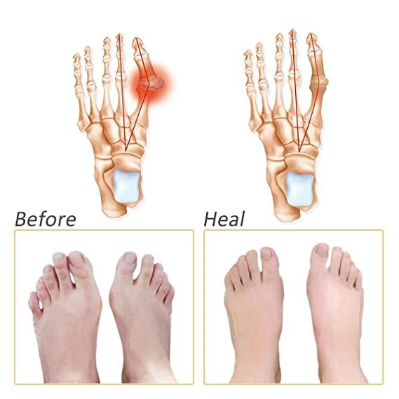 Soft Silicone Gel Half Toe Sleeve Forefoot Pads for Pain Relief